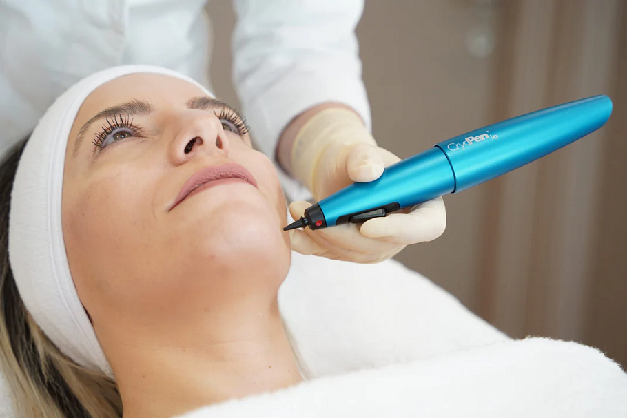 Cryopen for Skin Imperfections