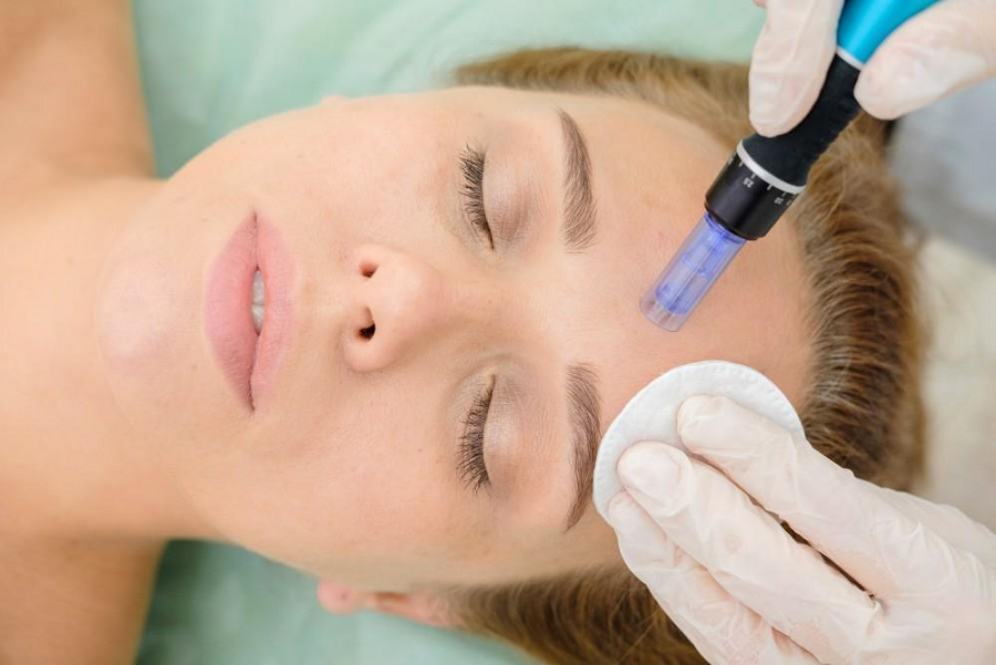 Microneedling for Smoother, Healthier Skin